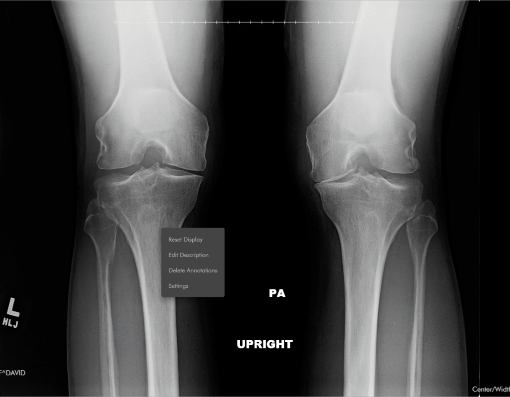 before x-ray of knee with arthritis