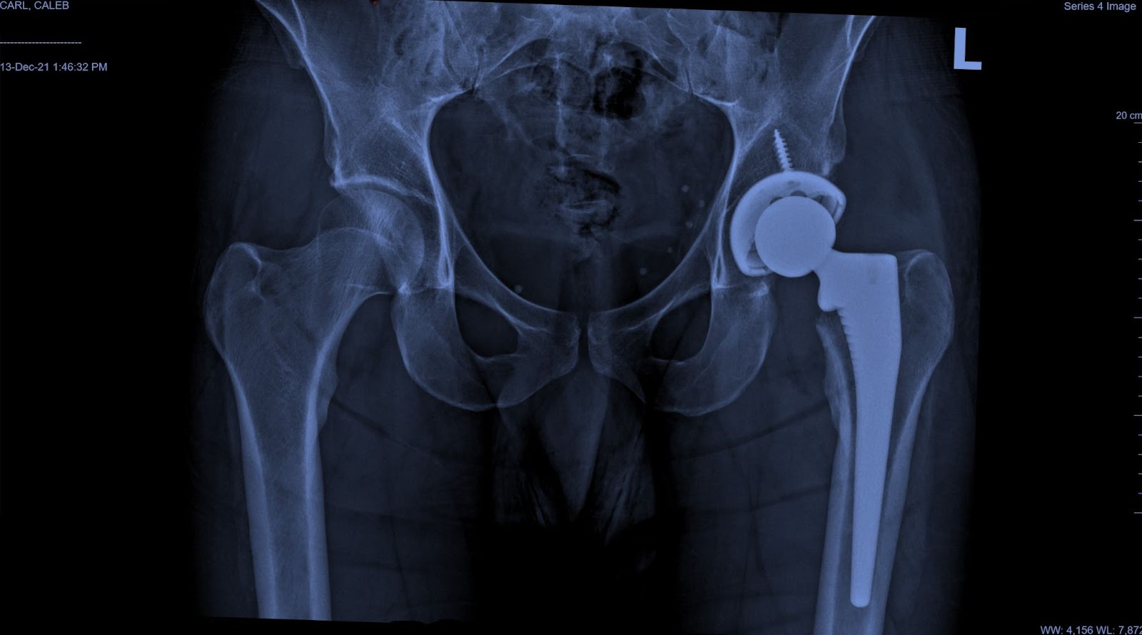 Hip surgical x-ray