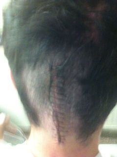 Cyclist JP Leclerc brain surgery scar